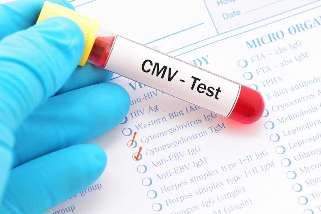 A gloved hand holds a vial labeled "CMV Test" over a lab requisition form for cytomegalovirus (CMV) test