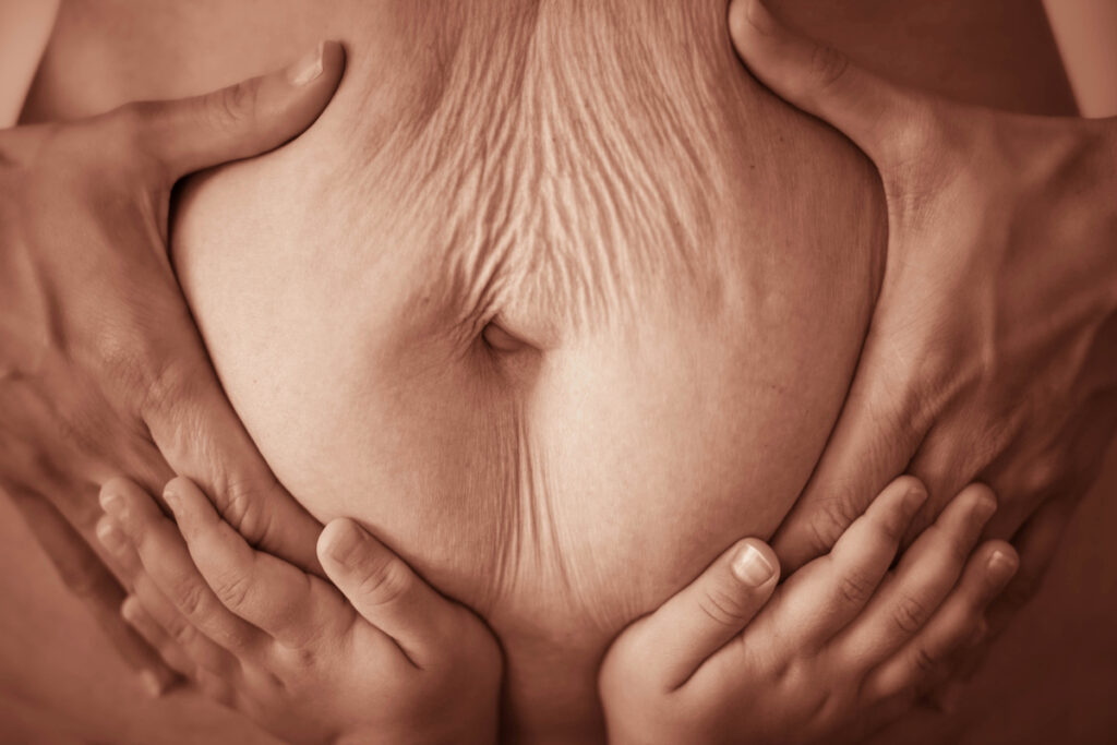Close up of a postpartum belly with baby hands.