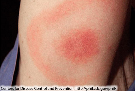 A close-up of a classic Lyme disease bullseye rash on an arm.