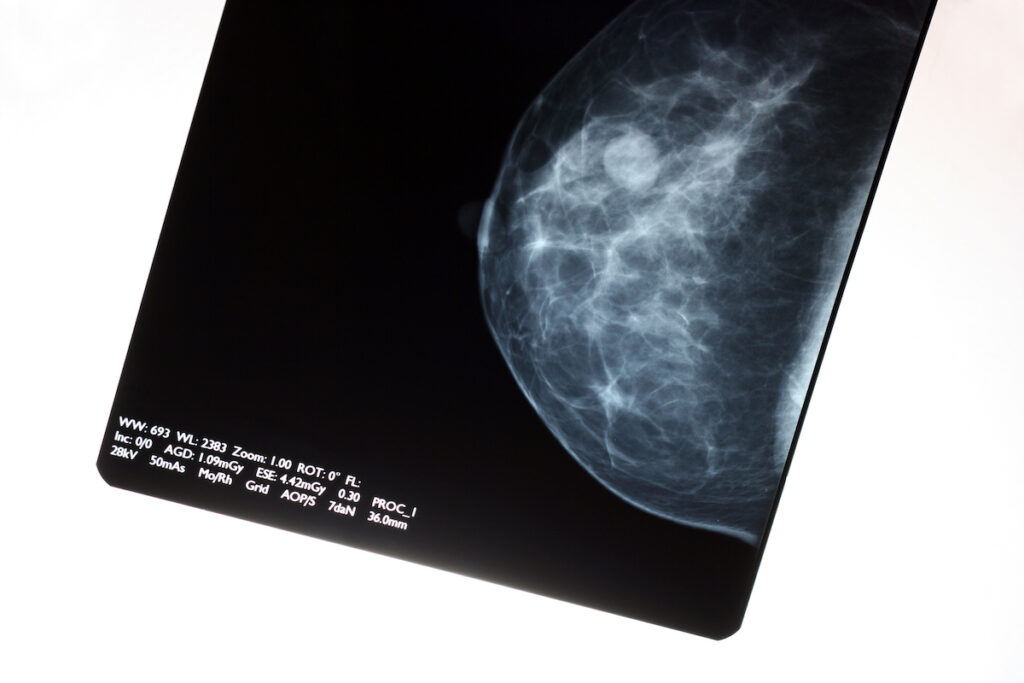 A mammogram image backlit over a whiteboard.