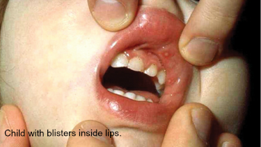 Image from the American Academy of Pediatrics showing a typical HFMD blister in a child's mouth.
