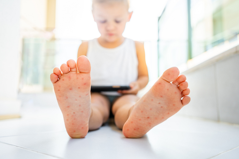 Close-up of HFMD blisters on a child's feet.