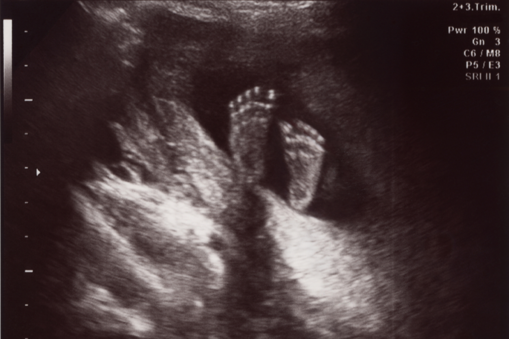 An ultrasound view of the bottoms of a baby's feet.