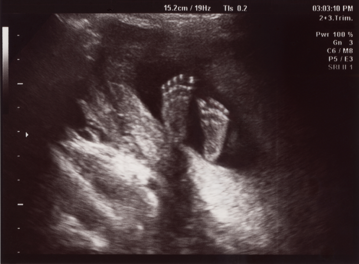 An ultrasound view of the bottoms of a baby's feet.