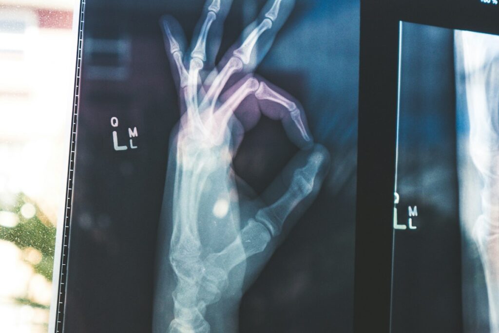 A hand makes the "ok" gesture in an xray to illustrate strong bones.