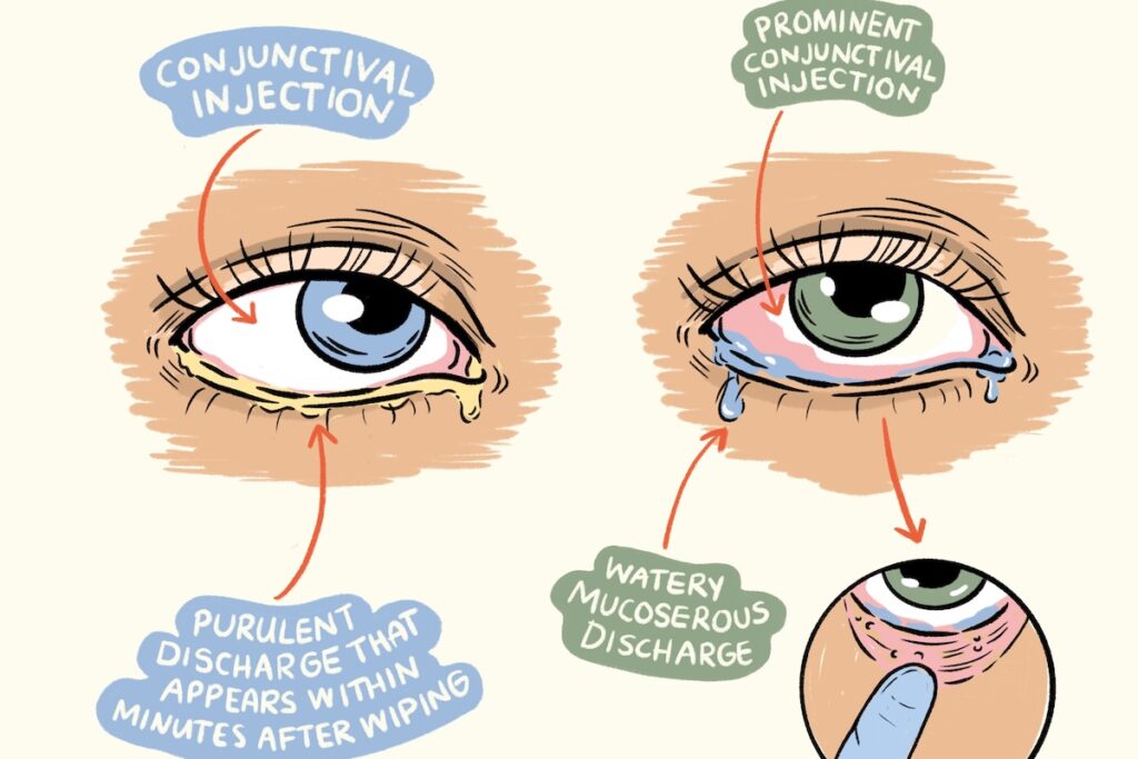 Illustration of different forms of conjunctivitis