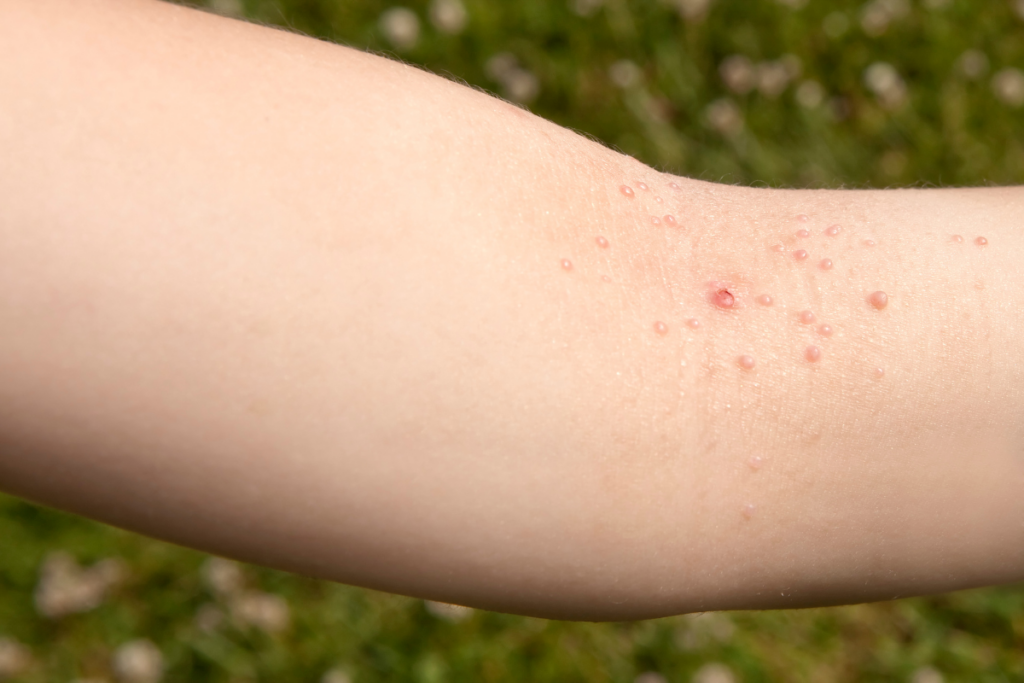 Tiny bumps on hand.