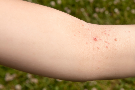 Tiny bumps on hand.