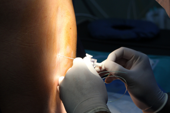 A pregnant person getting an epidural.