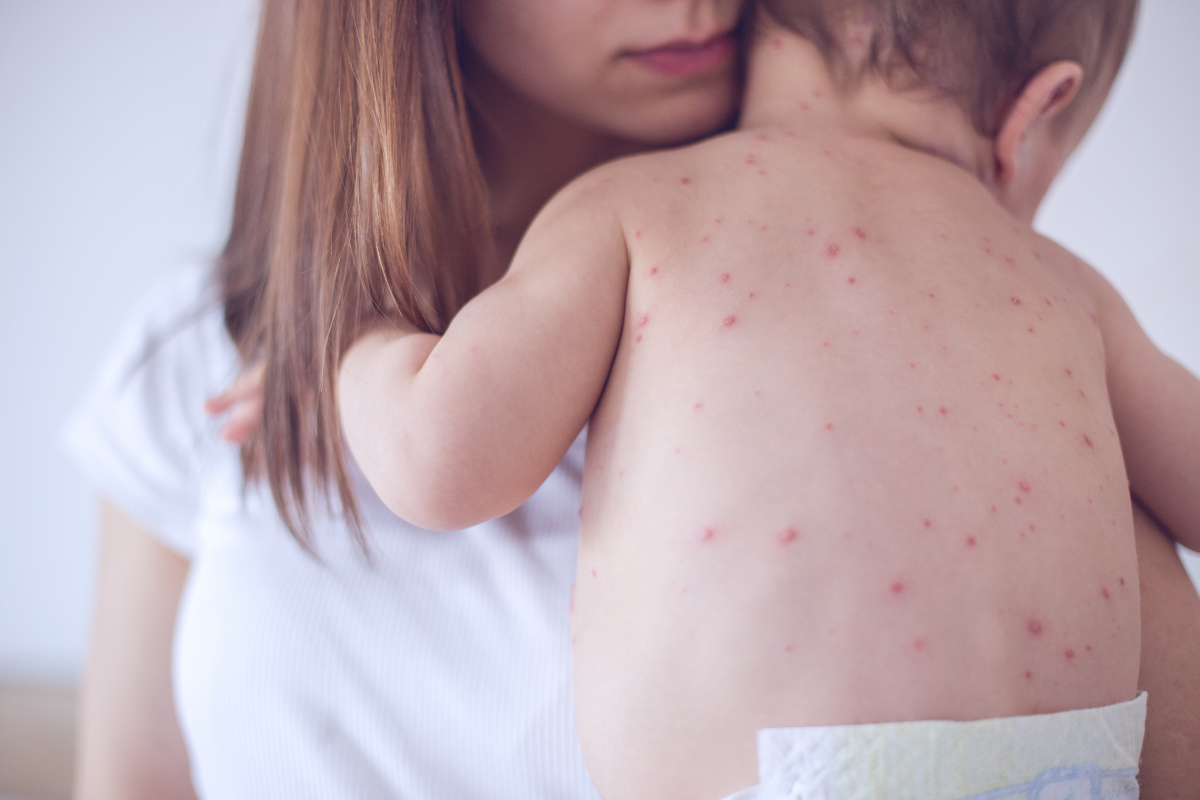 A mom holding her child who has measles.