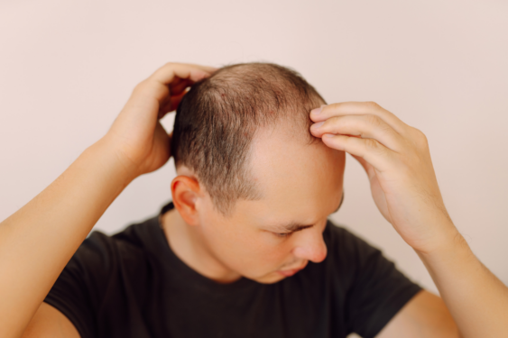 Man touching hair on his head